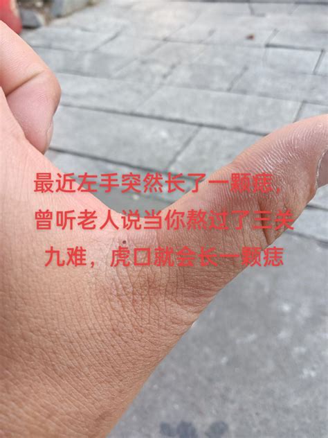 虎口突然長痣|突然长痣，是不是出了什么问题？